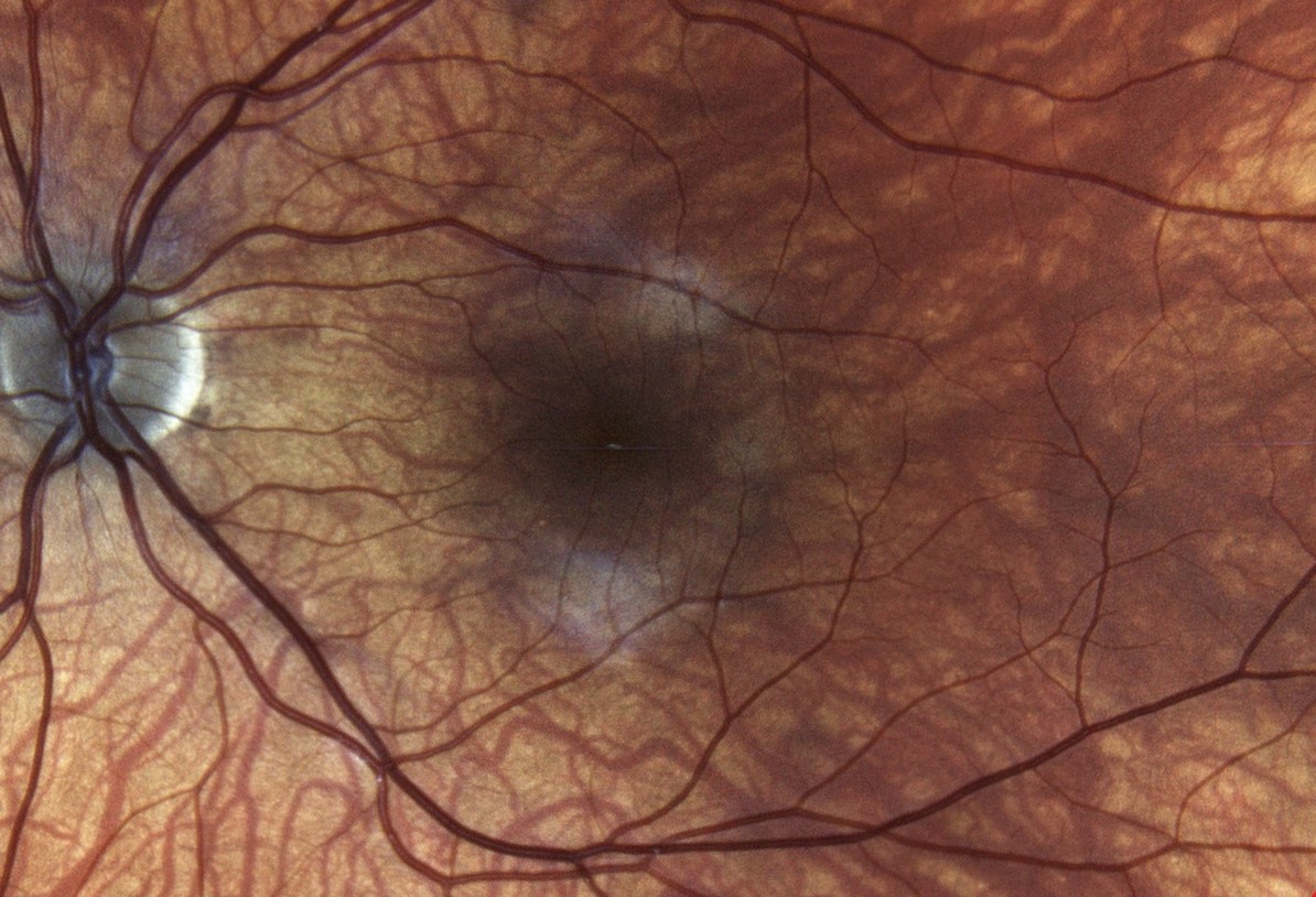 Ophthalmology
